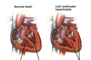 ABPM Used to Identify Masked Hypertension in Children with Chronic ...